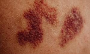 Czym jest wideodermatoskopia i dlaczego warto poddać się takiemu badaniu?
