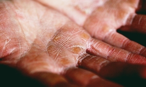 Genodermatozy – rzadkie choroby o podłożu genetycznym